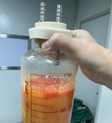 湘西水动力吸脂手术要做多久？